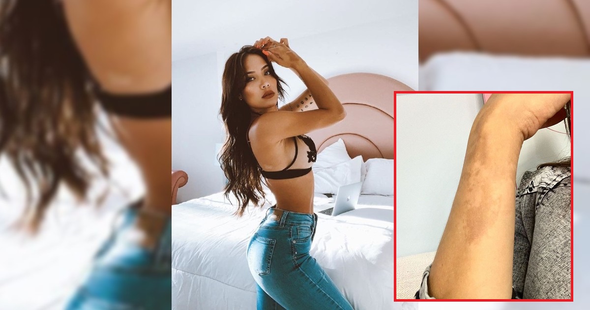 Luisa Fernanda W revela de qué son sus extrañas manchas por todo el cuerpo